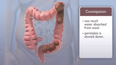 What Causes Constipation? on Make a GIF