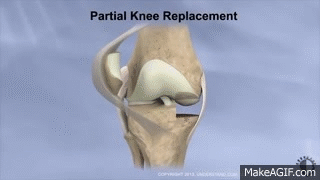 Partial Knee Replacement on Make a GIF