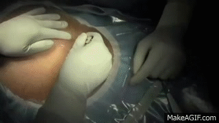 LSCS. Watch a Cesarean section from skin incision to ...