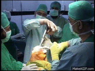 Live Total Knee Replacement - Civil Hospital Karachi (Dow Medical College)  - Part. 1 of 4 on Make a GIF