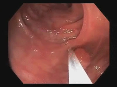 Removal of colon polyp(polypectomy)