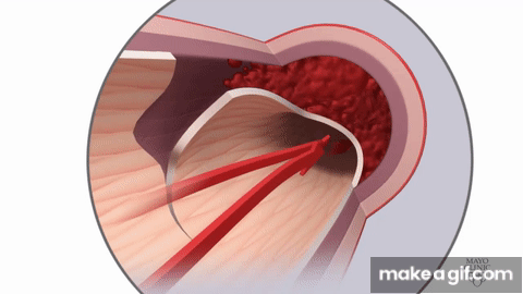 Spontaneous coronary artery dissection (SCAD) Animation on Make a GIF