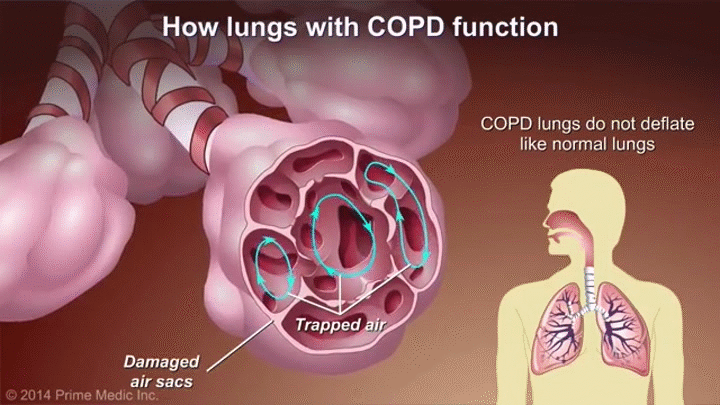 Understanding COPD on Make a GIF