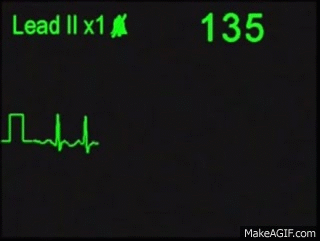 atrial fibrillation afib ecg