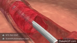 3D Animation of Coronary Stent Procedure on Make a GIF