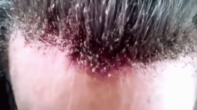 El Hombre Con mas PIOJOS del Mundo/ Hombre con la cabeza infestada de piojos  on Make a GIF