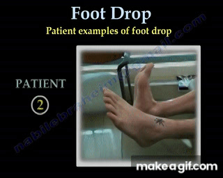 Foot Drop Peroneal Nerve Injury - Everything You Need To Know - Dr
