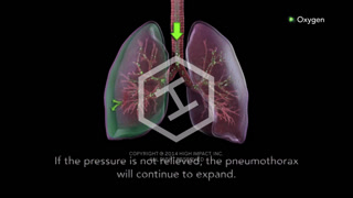 Tension Pneumothorax - Medical Animation on Make a GIF