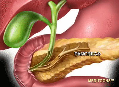 Gallstone Pancreatitis (Gallstone) - Meditoons™ on Make a GIF