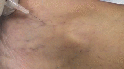 Spider Vein Sclerotherapy on Make a GIF