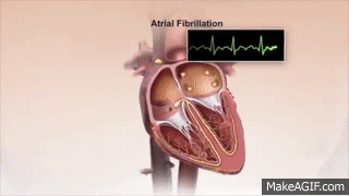 Normal Heart Rhythm and Atrial fibrillation on Make a GIF