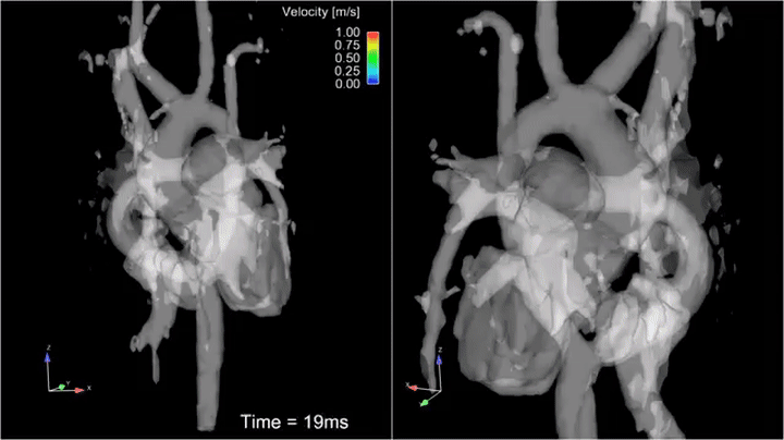 4D Flow MRI haemodynamic visualisation animation