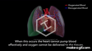 Tension Pneumothorax - Medical Animation on Make a GIF