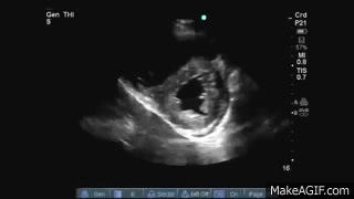 Right Ventricular Pressure Overload D sign On Echo PSAX View On Make A GIF