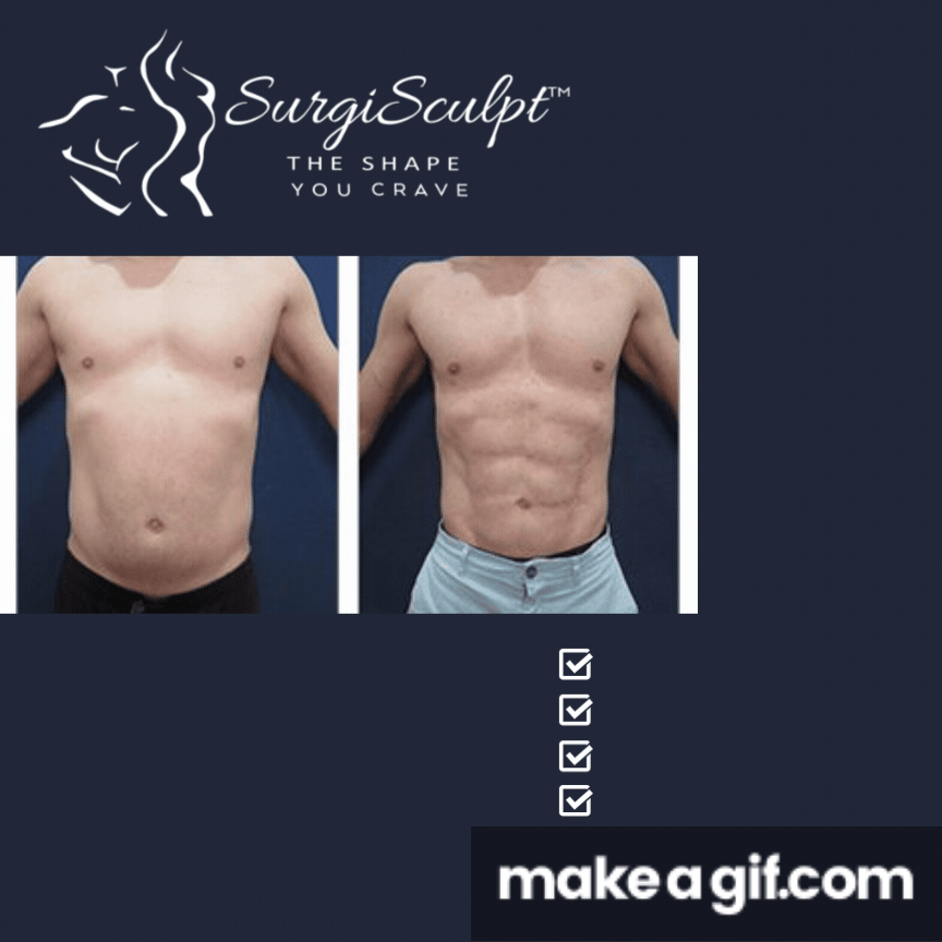 The Best Male liposuction of the Abdomen: SurgiSculpt on Make a GIF