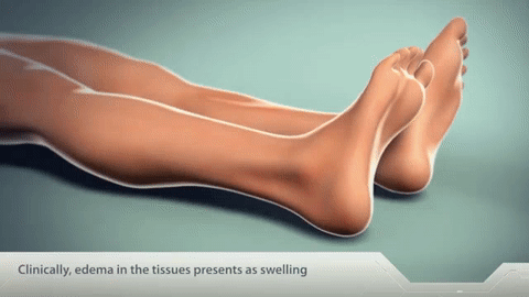 Consequences of Fluid Overload - Tissues on Make a GIF