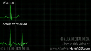 Atrial Fibrillation Anatomy, ECG and Stroke, Animation. on Make a GIF