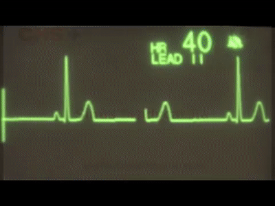 Sinus Bradycardia Ecg Training On Make A Gif