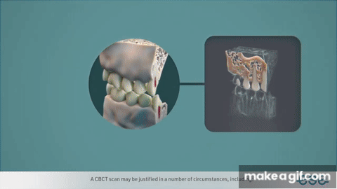 Cone Beam Computed Tomography CBCT in Endodontics on Make a GIF