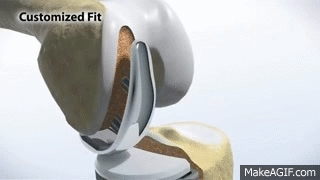 MAKOplasty Partial Knee Replacement on Make a GIF