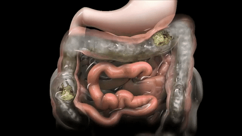 Síndrome de intestino irritable (colitis): criterios de ROMA on Make a GIF