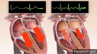 atrial fibrillation animation gif